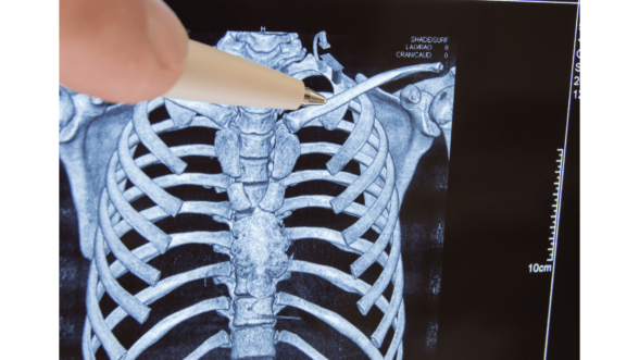 Odszkodowanie za złamanie obojczyka.