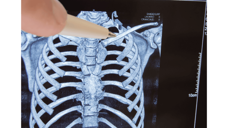 Odszkodowanie za złamany kręgosłup